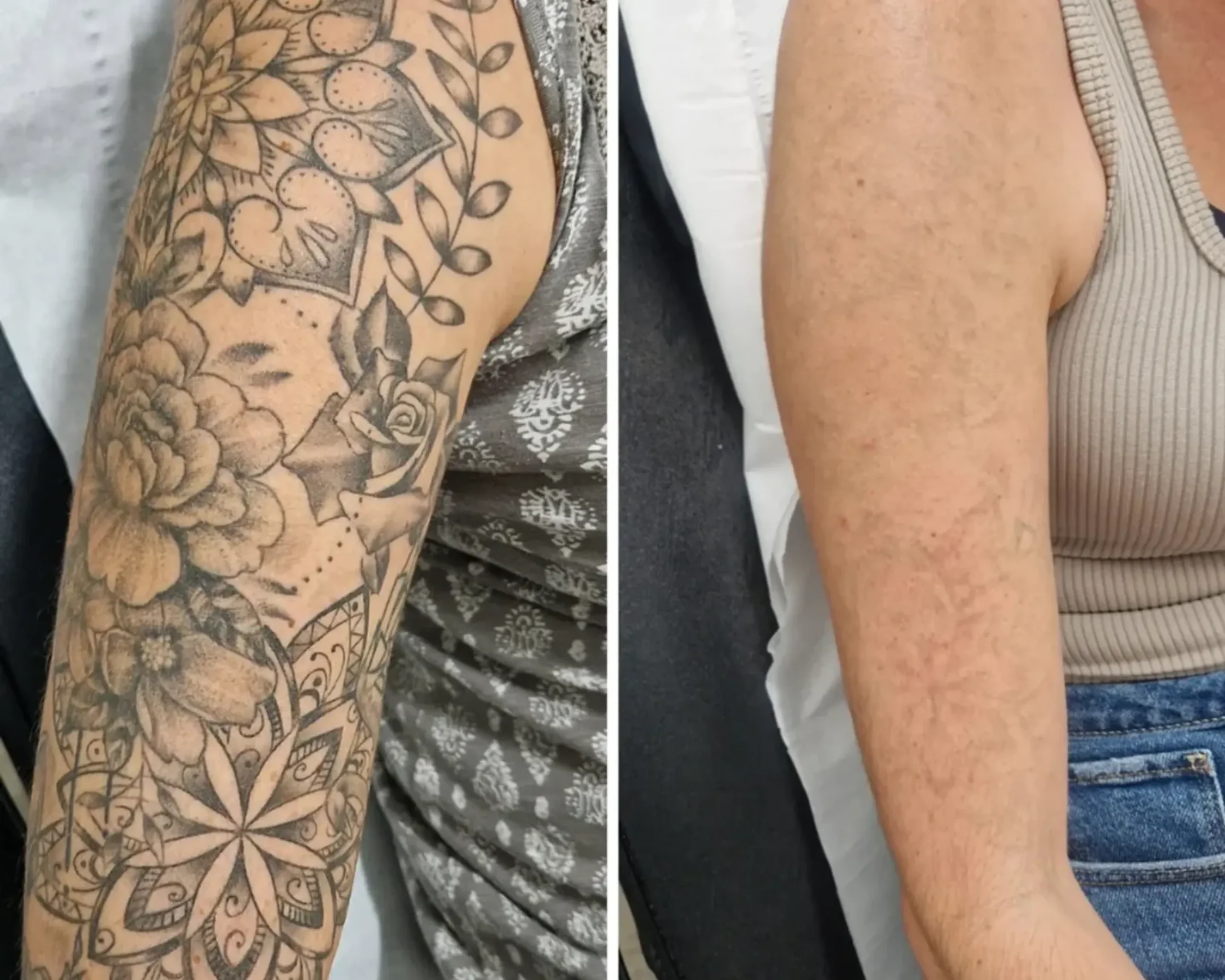 cosmetic ink removal price