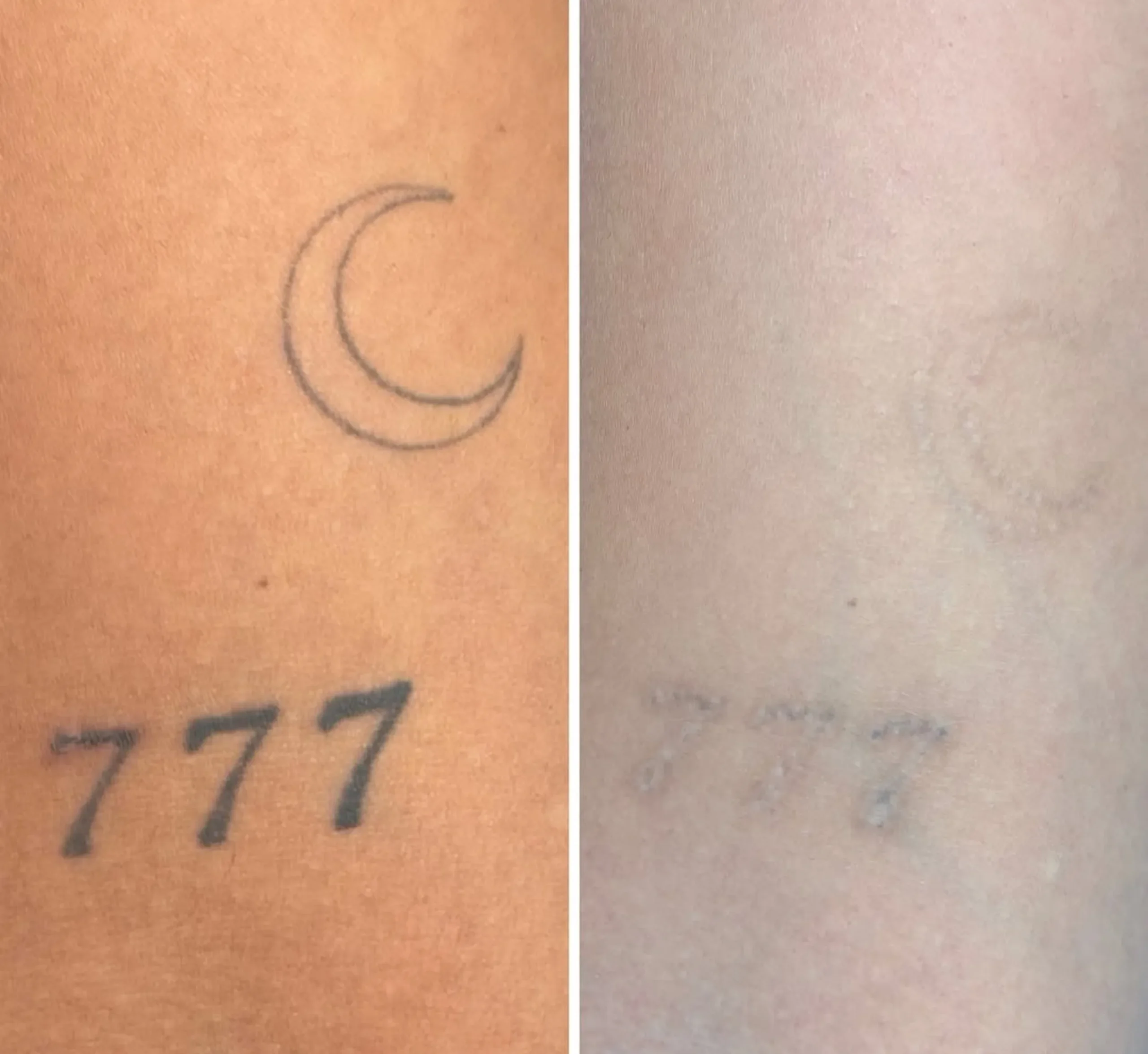 laser removal price small tattoo
