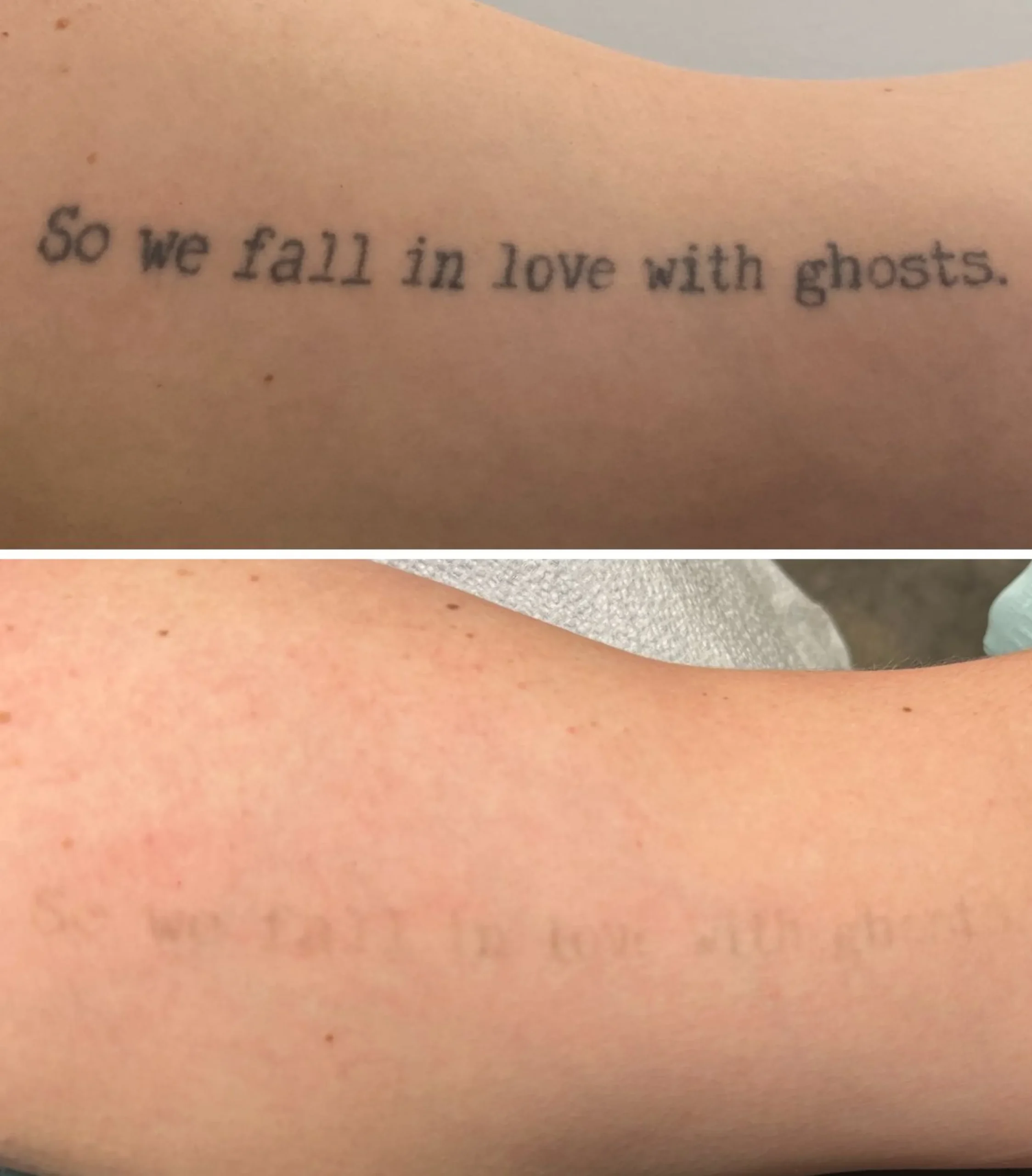 picosecond laser tattoo pricing