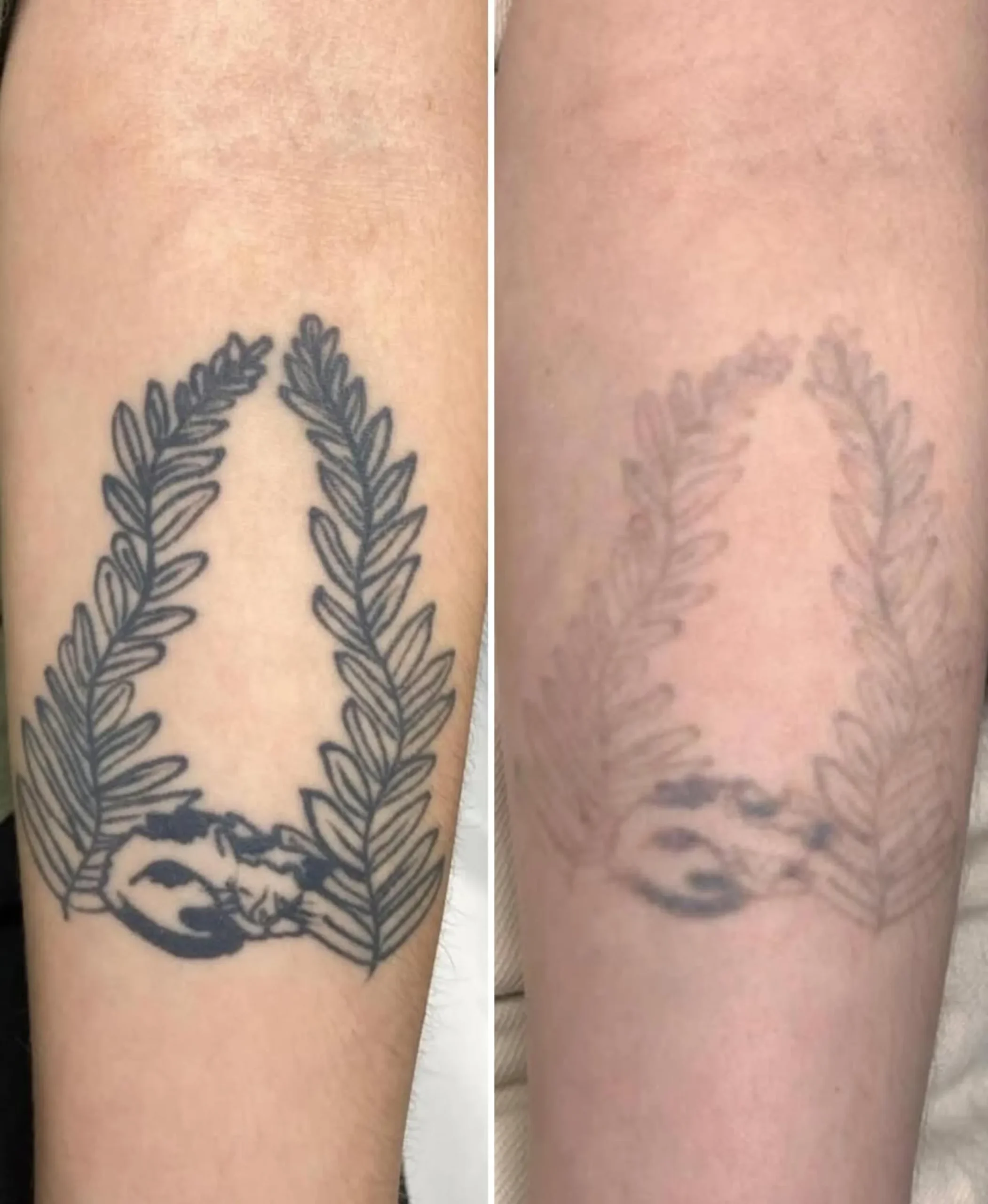 small tattoo removal cost Melbourne
