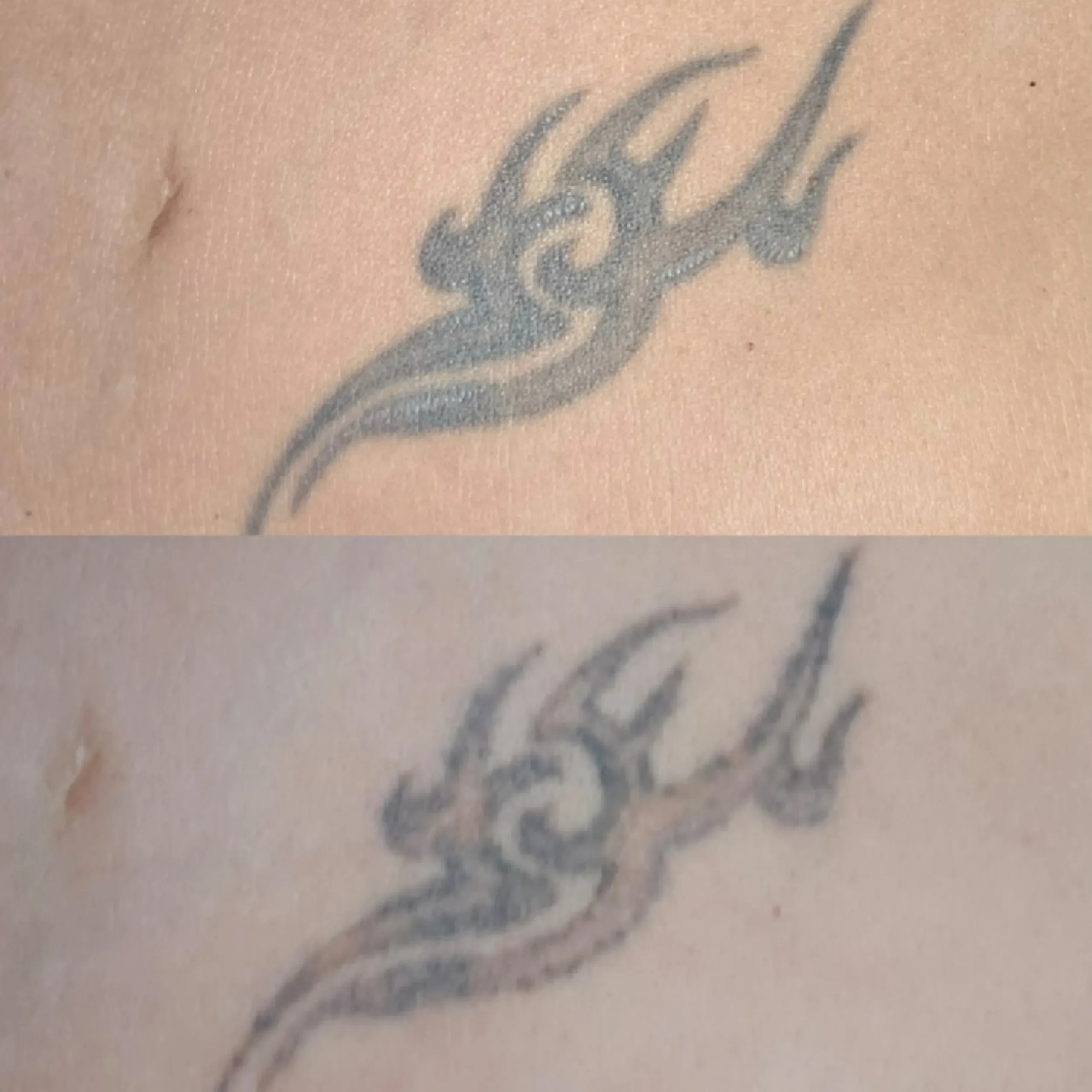 tiny tattoo laser removal sessions